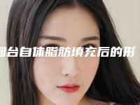 烟台自体脂肪填充后的形态自然吗自体脂肪填充都找烟台华怡