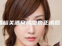 嘉峪关酒窝成型矫正术后护理常识