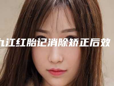 九江红胎记消除矫正后效果怎样