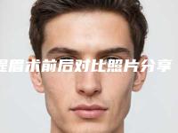 提眉术前后对比照片分享,眉眼精神了人就年轻了!