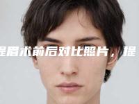 提眉术前后对比照片,提眉能取代割双眼皮吗