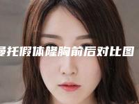 曼托假体隆胸前后对比图恢复过程分享手札