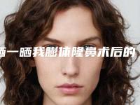 晒一晒我膨体隆鼻术后的恢复图(膨体隆鼻后怎么护理)