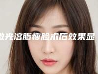 激光溶脂瘦脸术后效果显著吗(激光溶脂瘦脸安全有效)