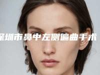 深圳市鼻中左侧偏曲手术医生哪个较好-深圳市鼻中左侧偏曲手术专家官宣