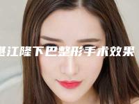 湛江隆下巴整形手术效果保持时间