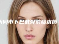 大同市下巴截骨前移术前十名私立医院盘点汇总(大同市下巴截骨前移术整形医院)