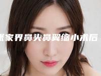 张家界鼻头鼻翼缩小术后遗症有多少