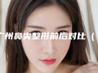 广州鼻尖整形前后对比（广州整形鼻子）