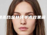 银汞合金补牙手术效果前后对比