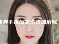 隆鼻手术后怎么快速消除