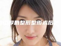 舟山厚唇整形整形术后护理工作