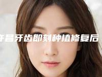 许昌牙齿即刻种植修复后遗症如何进行处理