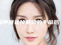 超声波祛掉眼袋的手前后注意事项以及禁忌人群