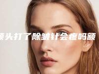 额头打了除皱针会疼吗额头打了除皱针要注意什么