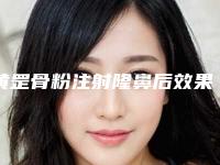 黄罡骨粉注射隆鼻后效果能够保持多久